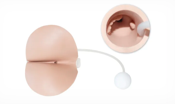 Pathologisches Perineum mit Analton